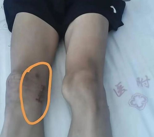 体育生被错切右膝 母亲:不接受和解 体育生被错切右膝 母亲:不接受和解